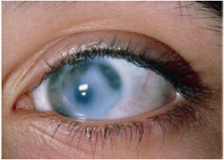 Glaucoma - WikicharliE