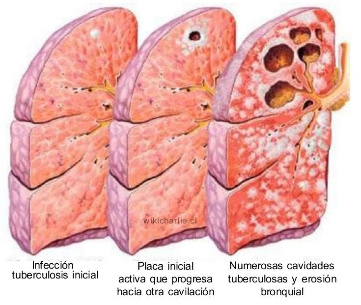 Tuberculosis Imagen.jpg
