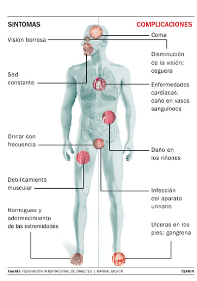 Neuropatía Diabética - WikicharliE