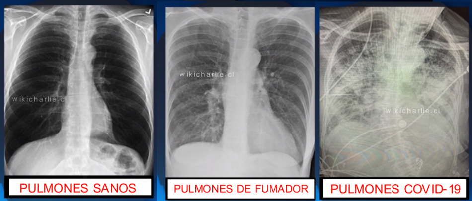 Un cirujano de "Texas Trauma Surgeon" dice: "Los pulmones post-COVID se ven peor que cualquier tipo de pulmón terrible para fumadores que hayamos visto". Los pulmones sanos están limpios y el negro representa el aire. En el pulmón del fumador, las líneas blancas son indicativas de cicatrización y congestión. Mientras que el pulmón COVID está lleno de blanco.